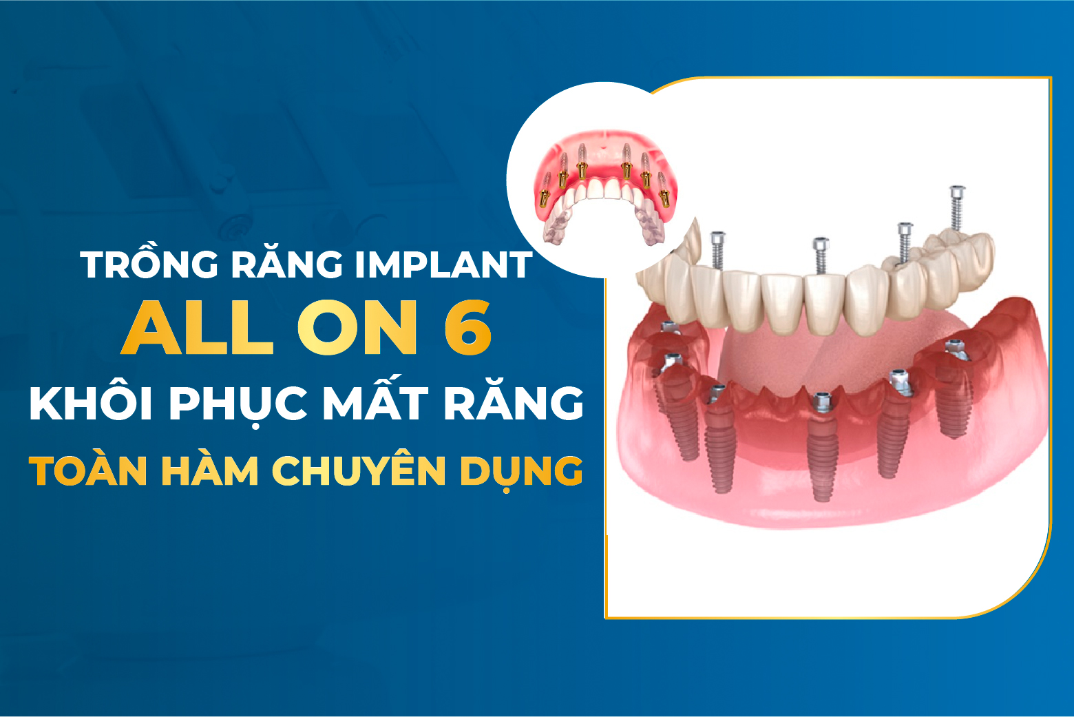 TƯ VẤN IMPLANT CHO TÔI