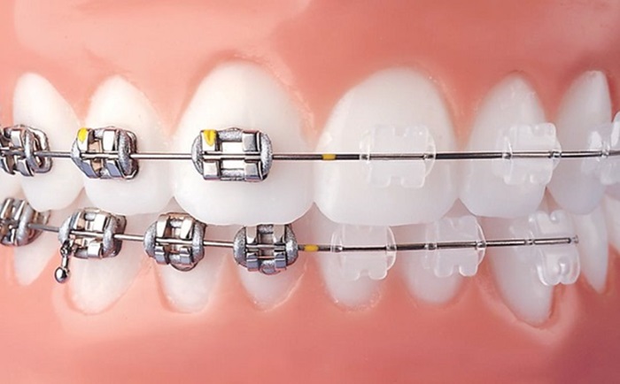 Niềng Răng – Giải Pháp Hoàn Hảo Cho Nụ Cười Đẹp Tự Nhiên