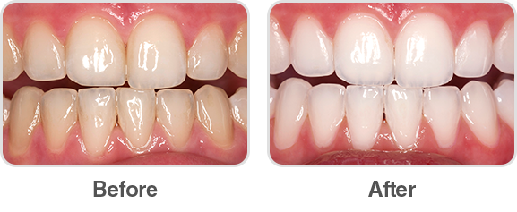 Răng Sứ Thẩm Mỹ – Giải Pháp Tái Tạo Nụ Cười Tự Nhiên & Bền Đẹp
